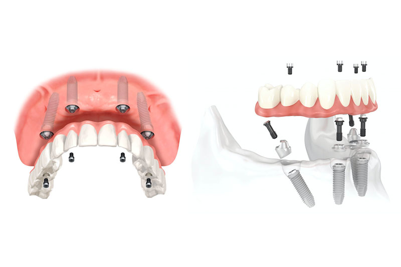 All on 4 implantátumos fogpótlás