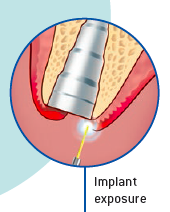 Implantátum beültetés lézersebészettel