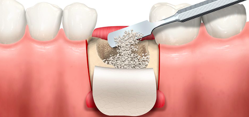 Páciens esettanulmány blog – Fogpótlás implantátummal 2. rész