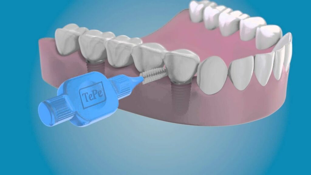 Hogyan tisztítsam az implantátumos fogpótlásomat?